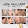 Hormonal Acne Supplement (5-HTP) - Natural DIM Supplement - Skin Care Vitamins - Hormone Balance, Antioxidants - Gluten Free